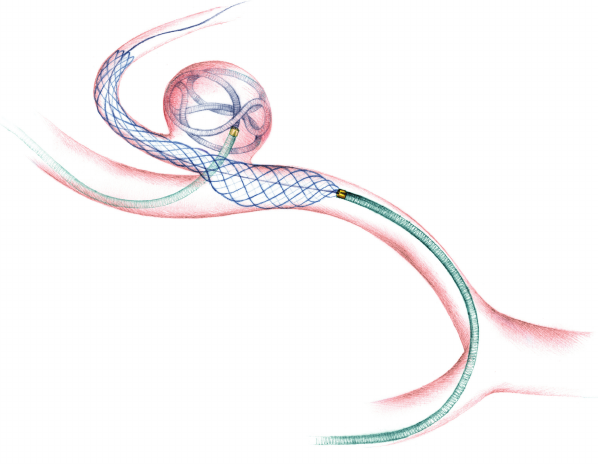 An-illustration-showing-the-LEO-Baby-stent-assisted-coiling-treatment-of-a-PICA-aneurysm